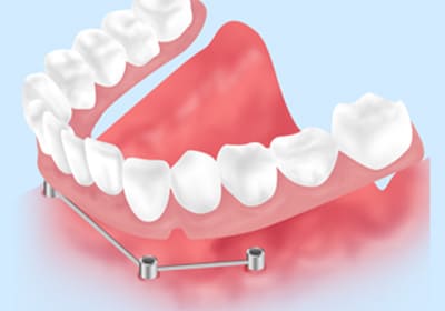 人気のインプラントデンチャー