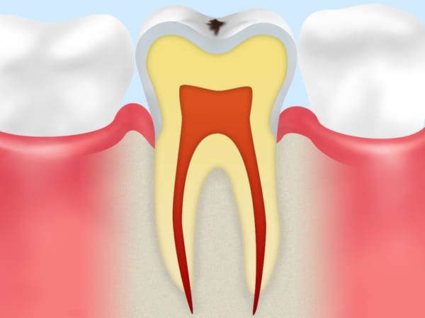 C0:初期の虫歯