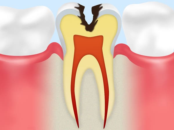 C2:象牙質の虫歯