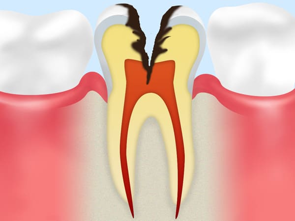 C3:歯の神経の虫歯