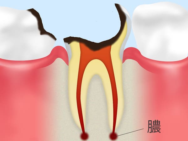 C4:歯の根の虫歯