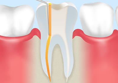 根管治療の流れ
