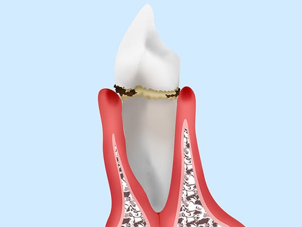 歯肉炎と歯周病の治療