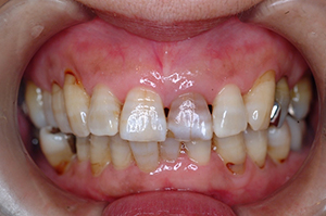 ②審美歯科（前歯部ジルコニア）1