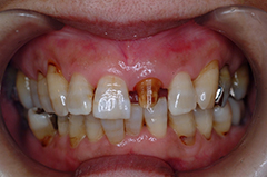 ②審美歯科（前歯部ジルコニア）2-1