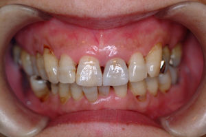 ②審美歯科（前歯部ジルコニア）3