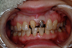 ③審美歯科（前歯部ジルコニア・歯肉整形）1-2