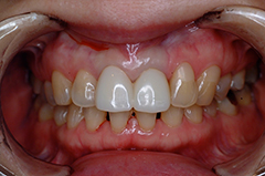 ③審美歯科（前歯部ジルコニア・歯肉整形）1-3