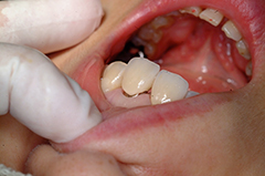 ③審美歯科（前歯部ジルコニア・歯肉整形）1-5