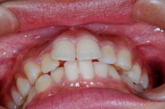 ④審美歯科（前歯部ジルコニア・歯列修正）1-2