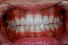 ④審美歯科（前歯部ジルコニア・歯列修正）1-3
