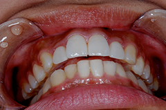 ④審美歯科（前歯部ジルコニア・歯列修正）1-4