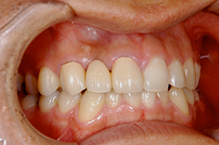 ⑦審美歯科（前歯部ジルコニア・歯肉移植・歯槽増大）1-1