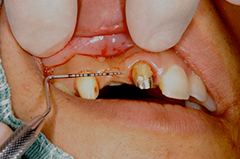 ⑦審美歯科（前歯部ジルコニア・歯肉移植・歯槽増大）1-2