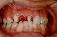 ⑦審美歯科（前歯部ジルコニア・歯肉移植・歯槽増大）1-3
