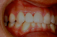 ⑦審美歯科（前歯部ジルコニア・歯肉移植・歯槽増大）1-4