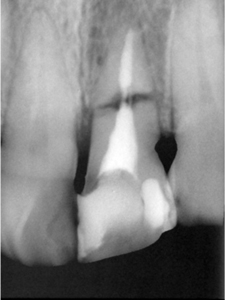 ⑥前歯部インプラント治療（歯根破折）1-2