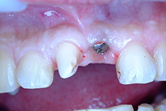 ⑥前歯部インプラント治療（歯根破折）2-1