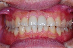⑥前歯部インプラント治療（歯根破折）3-1
