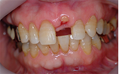 ⑦前歯部インプラント治療（打撲による歯冠破折）1-1
