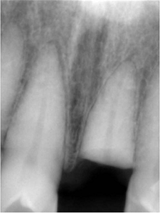 ⑦前歯部インプラント治療（打撲による歯冠破折）1-2