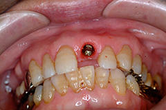 ⑦前歯部インプラント治療（打撲による歯冠破折）1-3