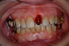 ⑦前歯部インプラント治療（打撲による歯冠破折）1-5