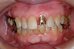 ⑦前歯部インプラント治療（打撲による歯冠破折）1-6