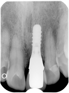 ⑦前歯部インプラント治療（打撲による歯冠破折）2-2
