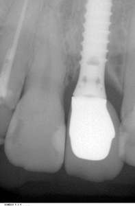 ⑧前歯部インプラント治療（虫歯による歯根吸収）1-2