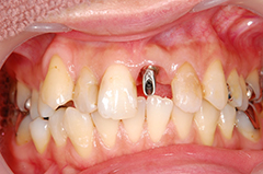 ⑧前歯部インプラント治療（虫歯による歯根吸収）1-3