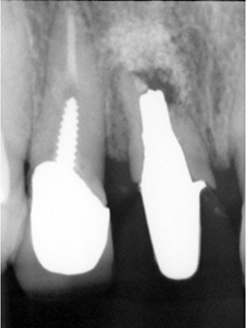 ⑧前歯部インプラント治療（虫歯による歯根吸収）1-6