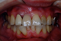 ⑧前歯部インプラント治療（虫歯による歯根吸収）1-7