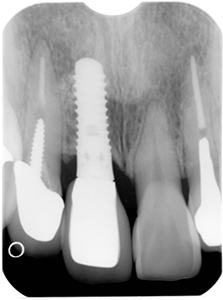 ⑧前歯部インプラント治療（虫歯による歯根吸収）1-8