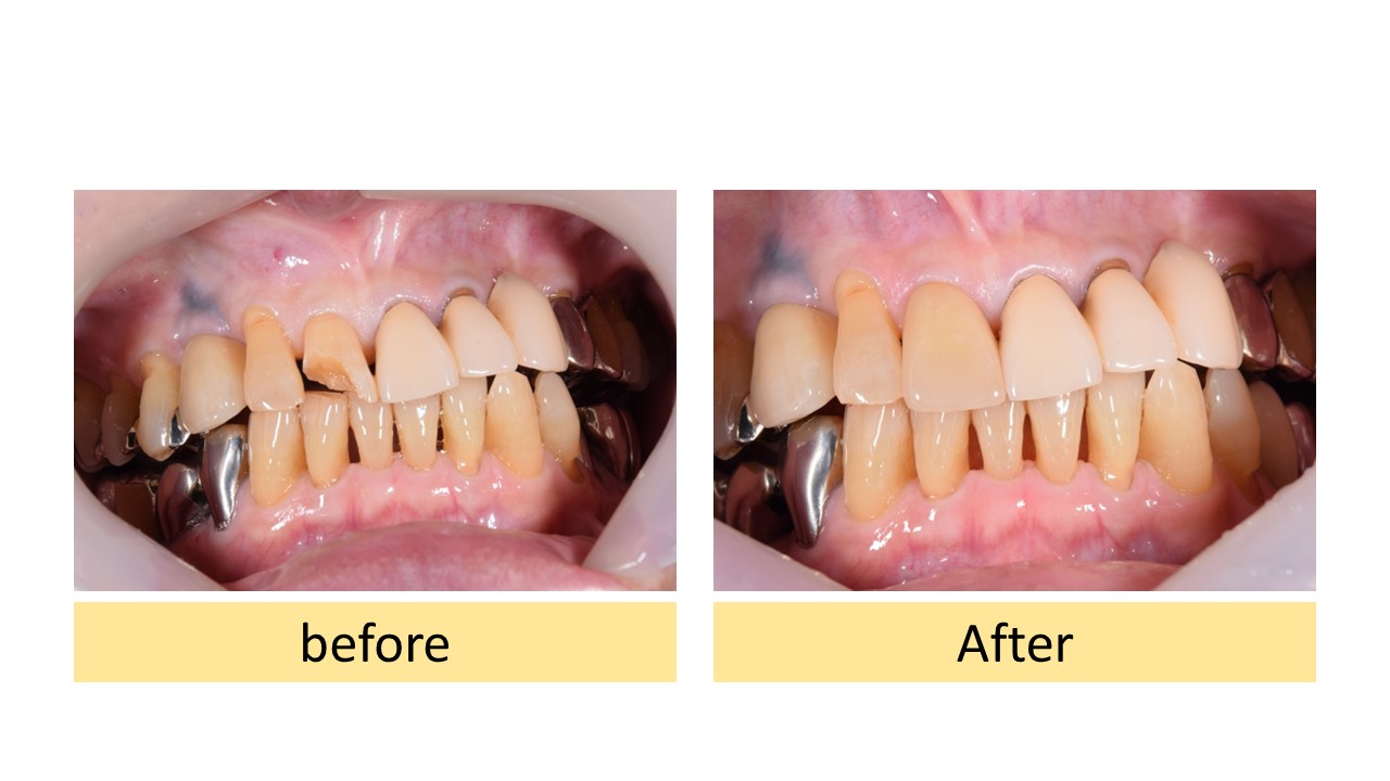 横浜市桜木町の歯医者「みらい歯科」症例｜【症例】転倒して欠けてしまった歯をジルコニアセラミックで修復｜ビフォアアフター画像