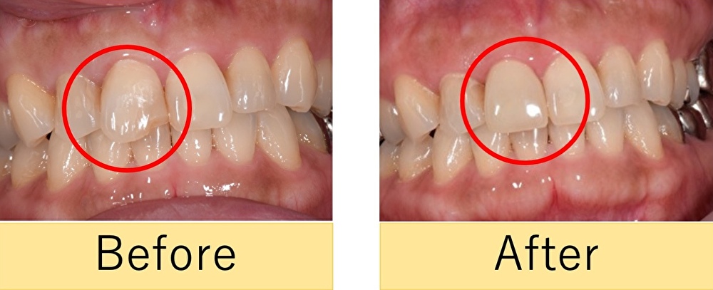 【症例】繰り返し欠けてしまう前歯をジルコニアセラミックで治療