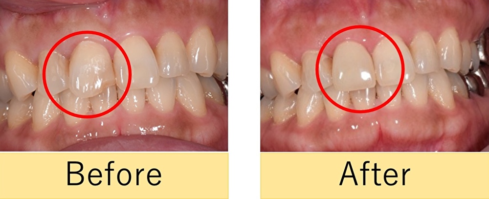 横浜市桜木町の歯医者「みらい歯科」症例｜【症例】繰り返し欠けてしまう前歯をジルコニアセラミックで治療｜アイキャッチビフォーアフター画像