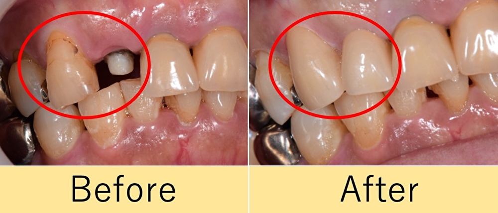 【症例】ジルコニアセラミックによる2本の前歯の清掃性を兼ね備えた審美的修復