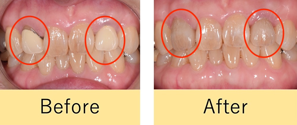 【症例】ジルコニアセラミックで自然な前歯を