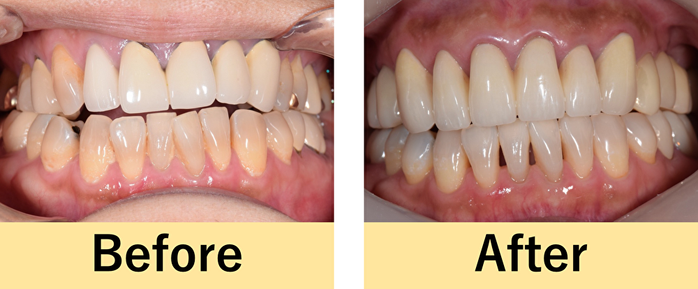 【症例】ジルコニアセラミックとマウスピース矯正を用いた噛み合わせ治療と前歯の審美治療