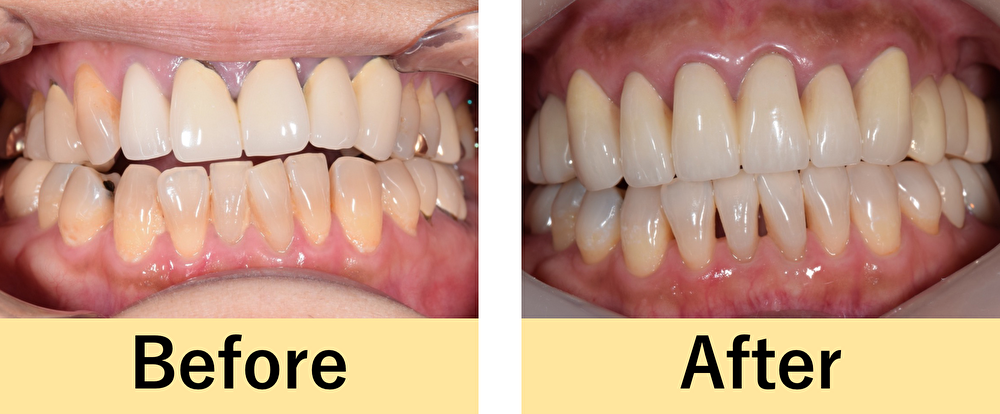 横浜市桜木町の歯医者「みらい歯科」症例｜【症例】ジルコニアセラミックとマウスピース矯正を用いた噛み合わせ治療と前歯の審美治療｜アイキャッチ画像