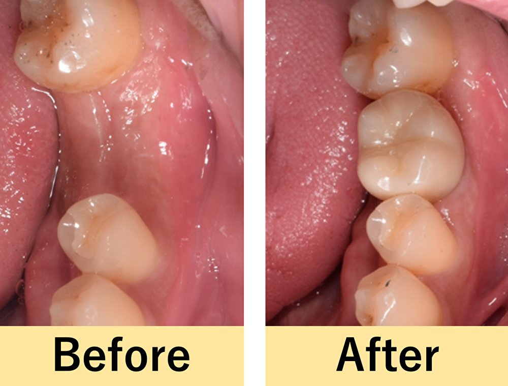 【症例】インプラント治療で、以前のように奥歯で噛めるように！