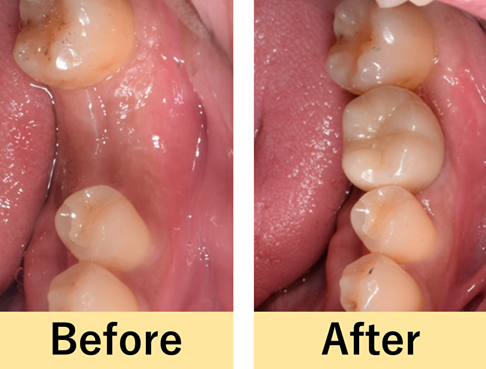横浜市桜木町の歯医者「みらい歯科」症例｜【症例】インプラント治療で、以前のように奥歯で噛めるように！｜アイキャッチ画像