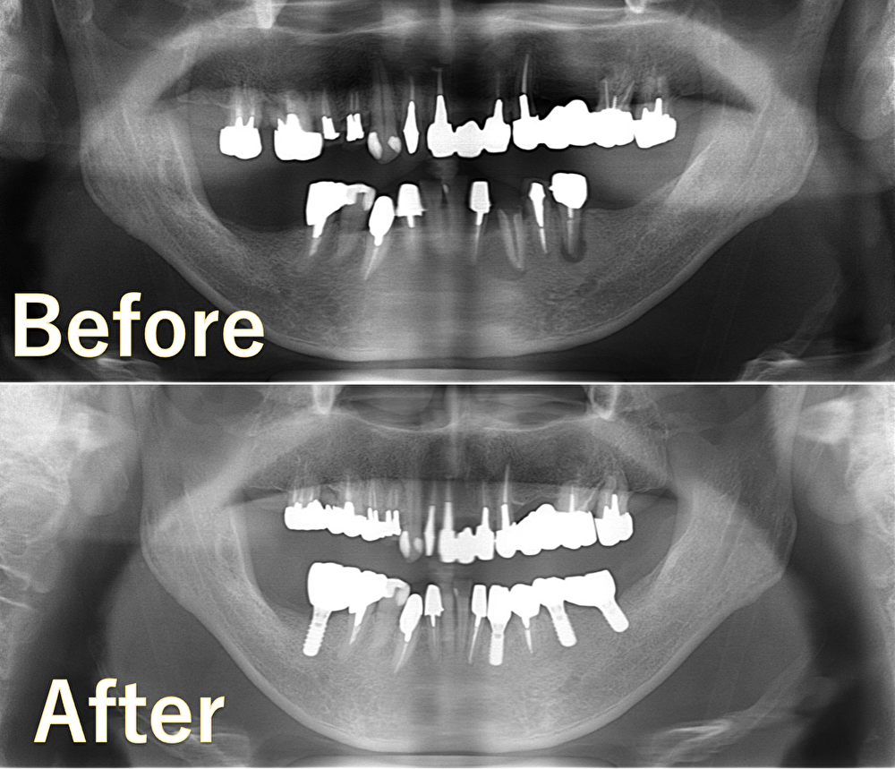 【症例】大きな骨欠損に対して骨造成を行い、入れ歯からインプラントへ