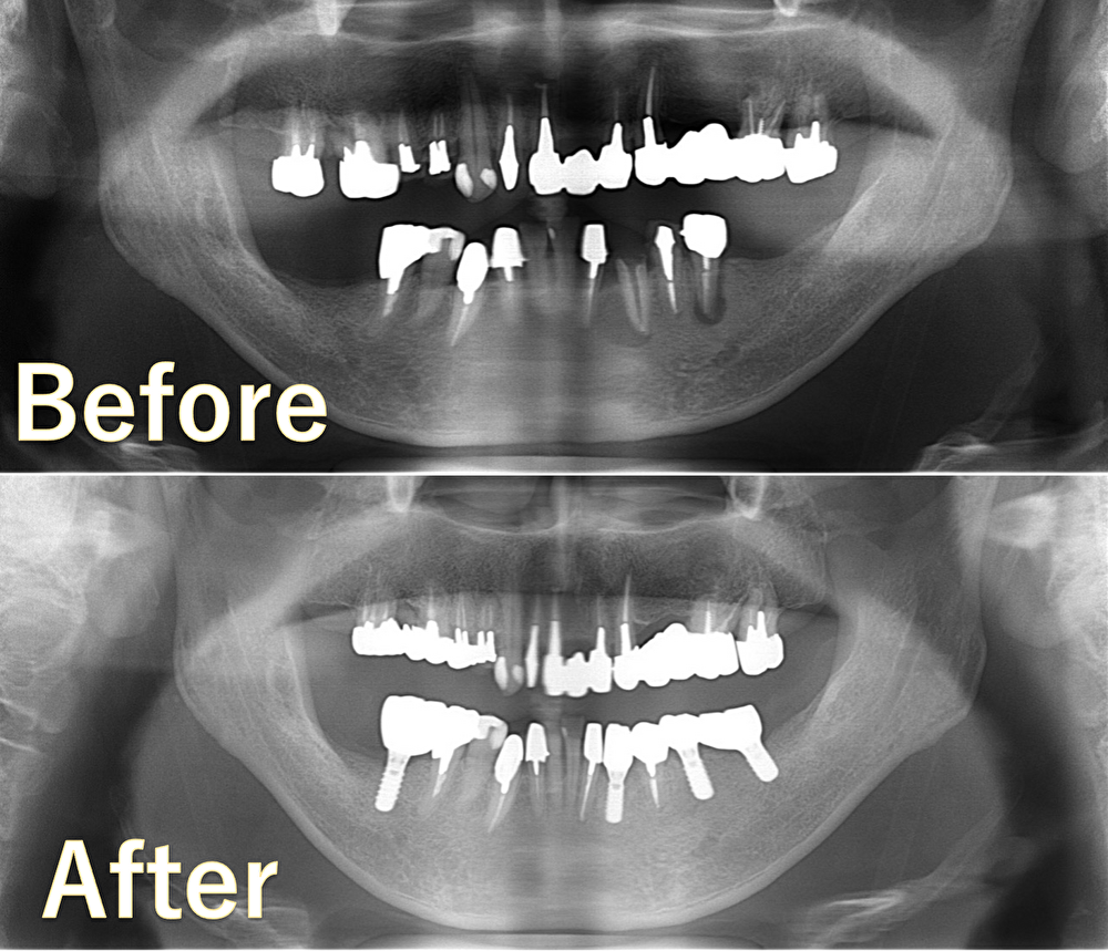 横浜市桜木町の歯医者「みらい歯科」症例｜【症例】大きな骨欠損に対して骨造成を行い、入れ歯からインプラントへ｜アイキャッチ画像