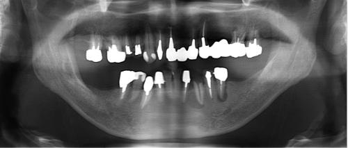 横浜市桜木町の歯医者「みらい歯科」症例｜【症例】大きな骨欠損に対して骨造成を行い、入れ歯からインプラントへ｜治療前画像
