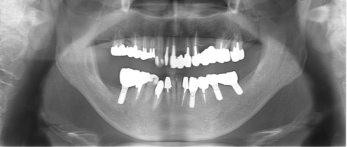 横浜市桜木町の歯医者「みらい歯科」症例｜【症例】大きな骨欠損に対して骨造成を行い、入れ歯からインプラントへ｜治療後画像