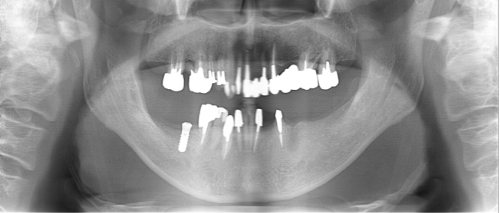 横浜市桜木町の歯医者「みらい歯科」症例｜【症例】大きな骨欠損に対して骨造成を行い、入れ歯からインプラントへ｜手術後画像1