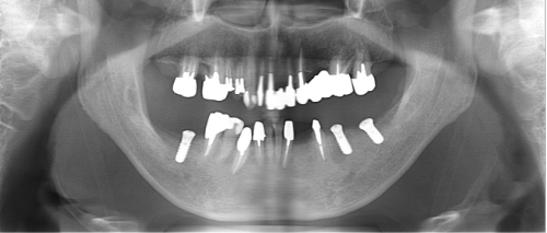 横浜市桜木町の歯医者「みらい歯科」症例｜【症例】大きな骨欠損に対して骨造成を行い、入れ歯からインプラントへ｜手術後画像2