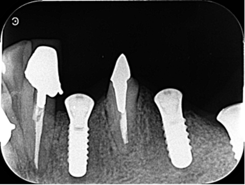 横浜市桜木町の歯医者「みらい歯科」症例｜【症例】大きな骨欠損に対して骨造成を行い、入れ歯からインプラントへ｜インプラント埋入画像